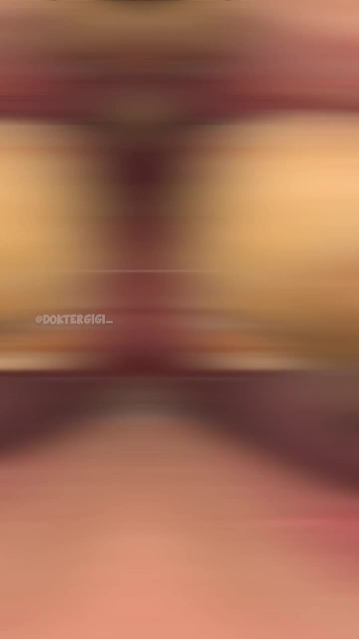 약혐) 거대 치석 스케일링 ㄷㄷ..jpg